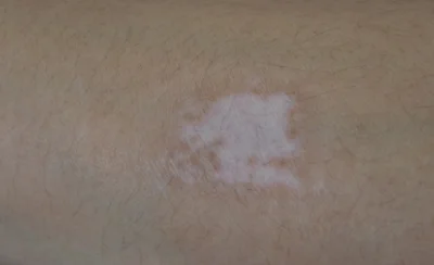 arm-3