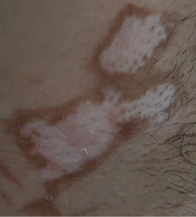 underarm-2