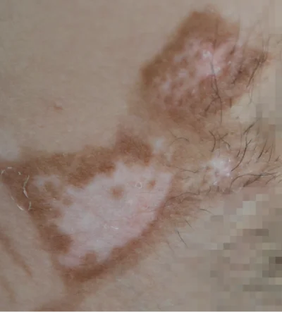 underarm-3