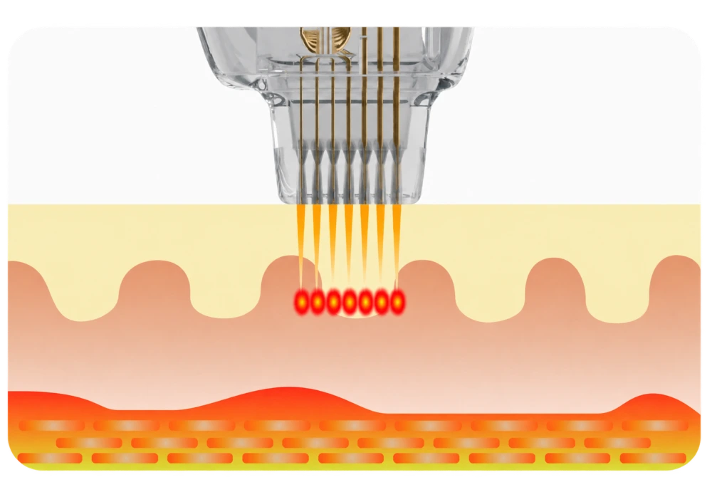 MicroRF energy delivery in the dermis