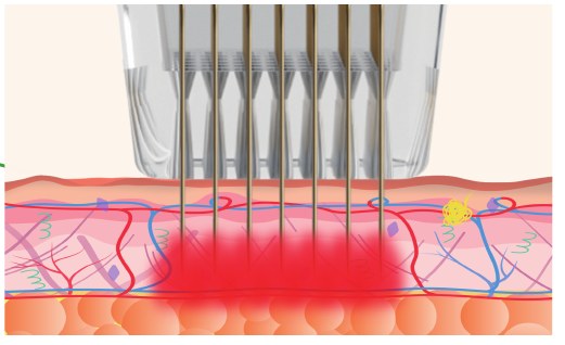Needle engagement without vacuum