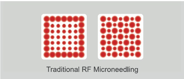 Traditional RF microneedling firing pattern
