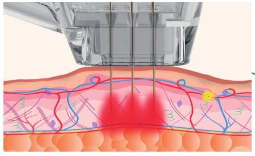 Needle engagement with vacuum